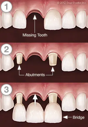dental bridge picture